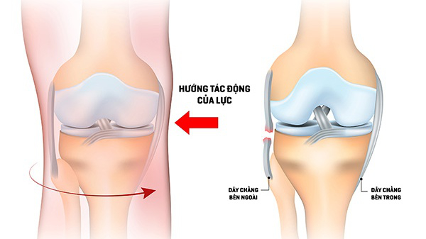 chấn thương đầu gối