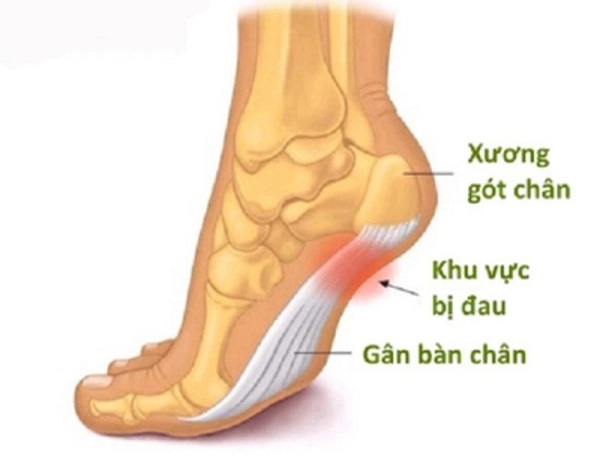 chấn thương phổ biến khi chạy bộ